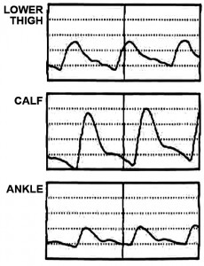 Decreased Pulse Volume at the Ankle