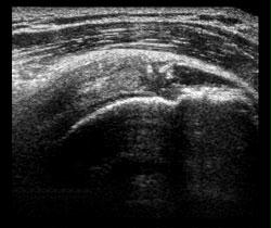 Ultrasound Calcified Subscapularis Tendon