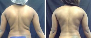 Laser Liposuction from Piedmont PMR