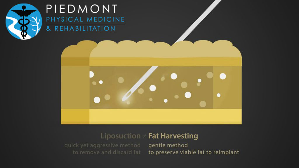 osteoarthritis treatment